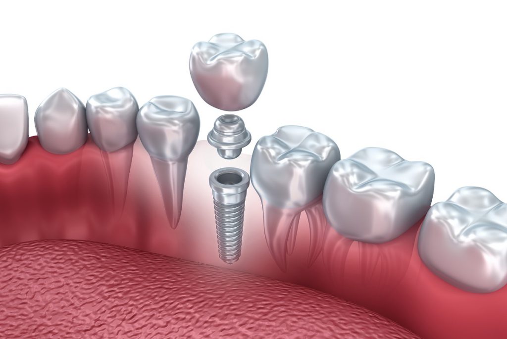 Dental Implant Chicago