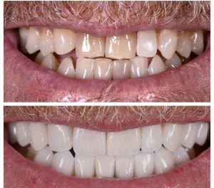 Porcelain Veneers Before and After Patient 21