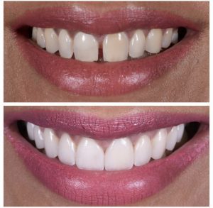 Porcelain Veneers Before and After Patient 32