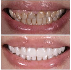 Porcelain Veneers Before and After Patient 30