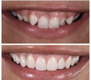 Porcelain Veneers Before and After Patient 19