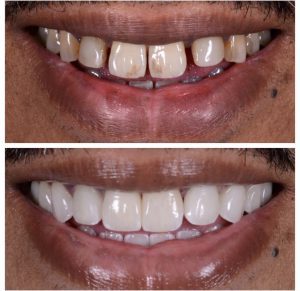 Porcelain Veneers Before and After Patient 25