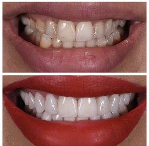 Porcelain Veneers Before and After Patient 31