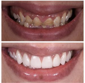 Porcelain Veneers Before and After Patient 20