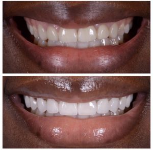 Porcelain Veneers Before and After Patient 29