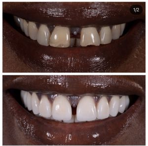 Porcelain Veneers Before and After Patient 22