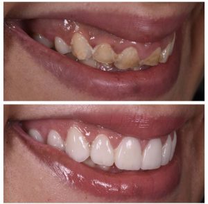 Porcelain Veneers Before and After Patient 28