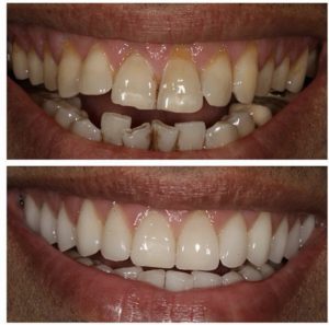 Porcelain Veneers Before and After Patient 27
