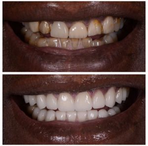 Porcelain Veneers Before and After Patient 24