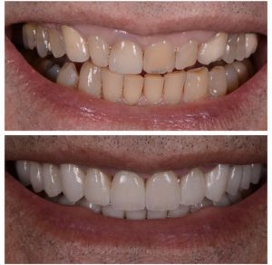 Porcelain Veneers Before and After Patient 26