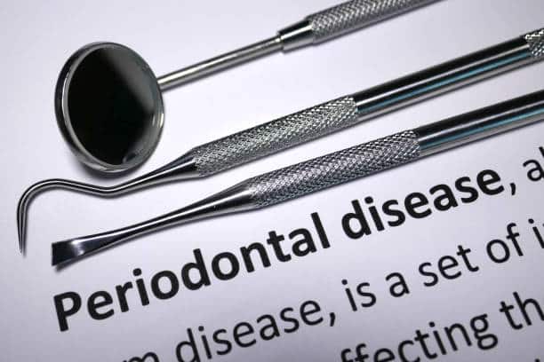 Inflammatory Periodontal Disease