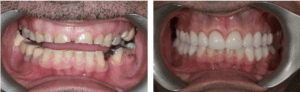 Dental Implants Before and After Patient 1