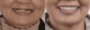 Dental Implants Before and After Patient 2