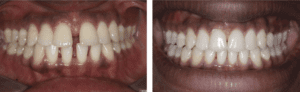 Invisalign Before and After Results 1