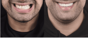 Porcelain Veneers Before and After Patient 1