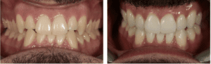 Porcelain Veneers Before and After Patient 18