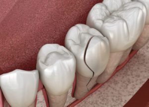 cracked teeth - tooth pain