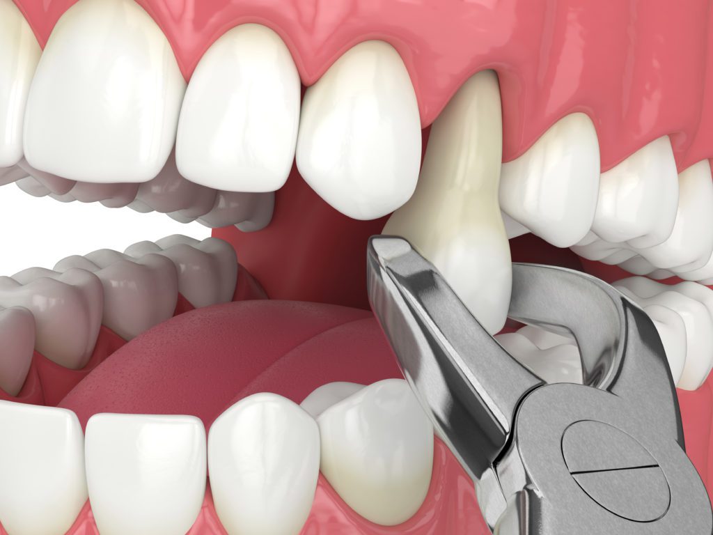 Chicago Dental Arts offers tooth extraction in Chicago, IL.