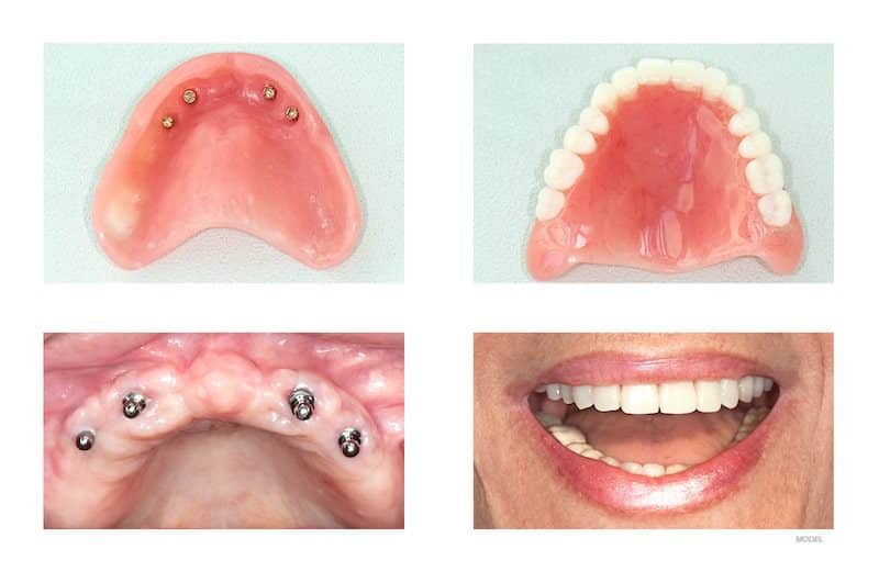  One case of a patient with All-on-4® dental implants is depicted in four photos: two of the dentures, one of the inserted implants, and the beautiful smile that can be achieved with this tooth replacement method