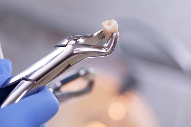 A dental tool grasps an extracted tooth.