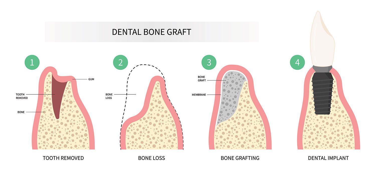 Diagram of the bone grafting procedure
