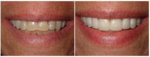 Porcelain Crowns Before and After Treatment Patient 2