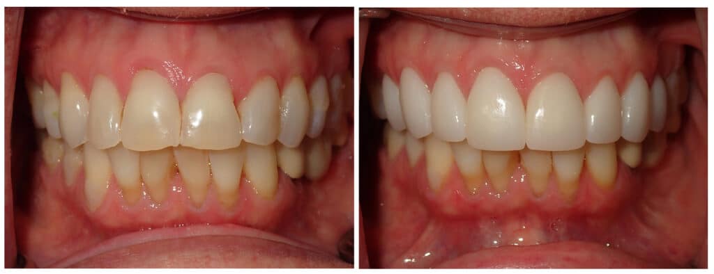 before and after patient photo
