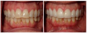 Porcelain Crowns Before and After Treatment Patient 1