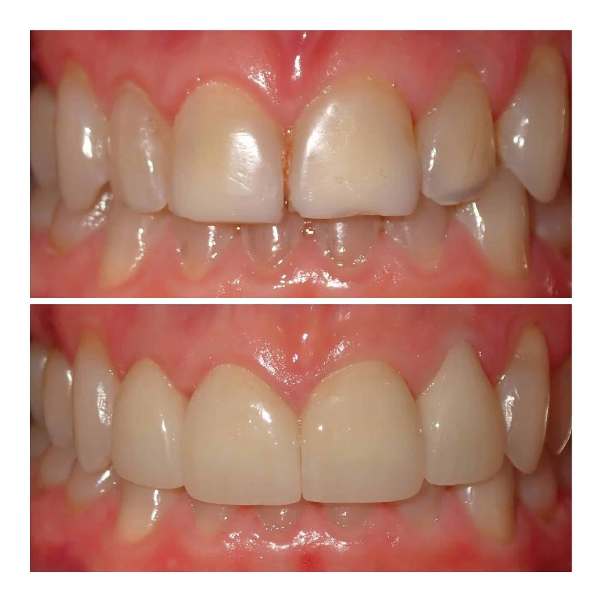 Crowns actual patient results 2
