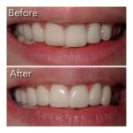 Dental veneer before and after photo 25