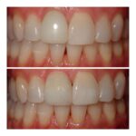 Dental implant before and after photo